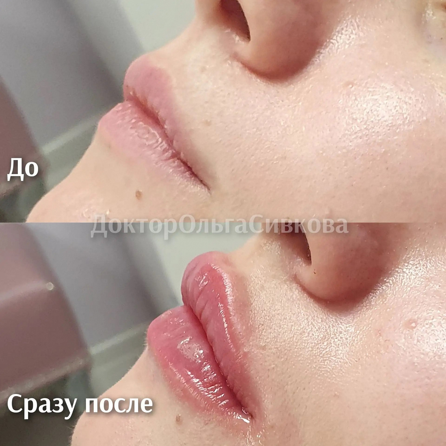 Коррекция губ