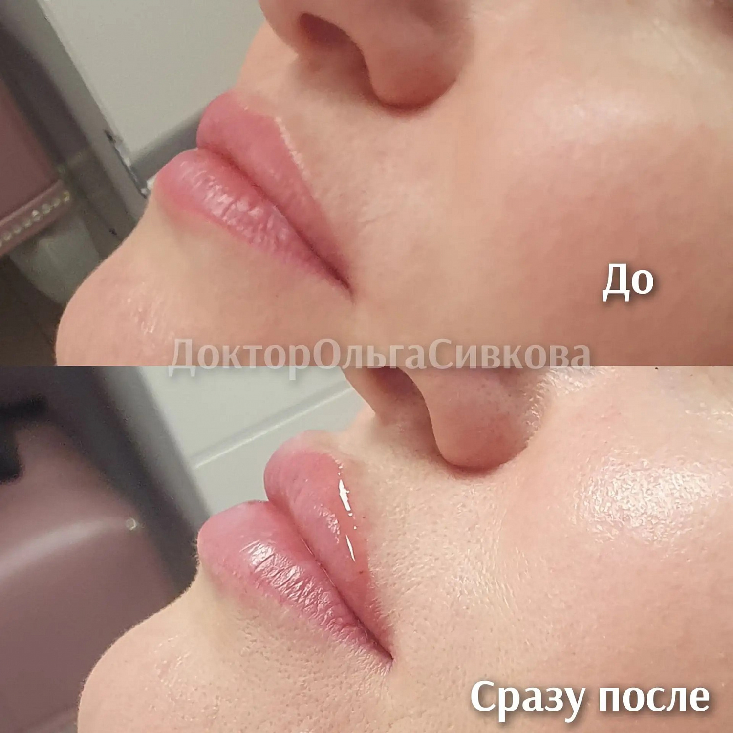 Коррекция губ
