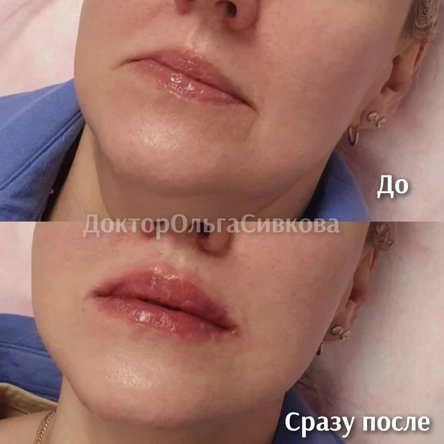 Коррекция губ