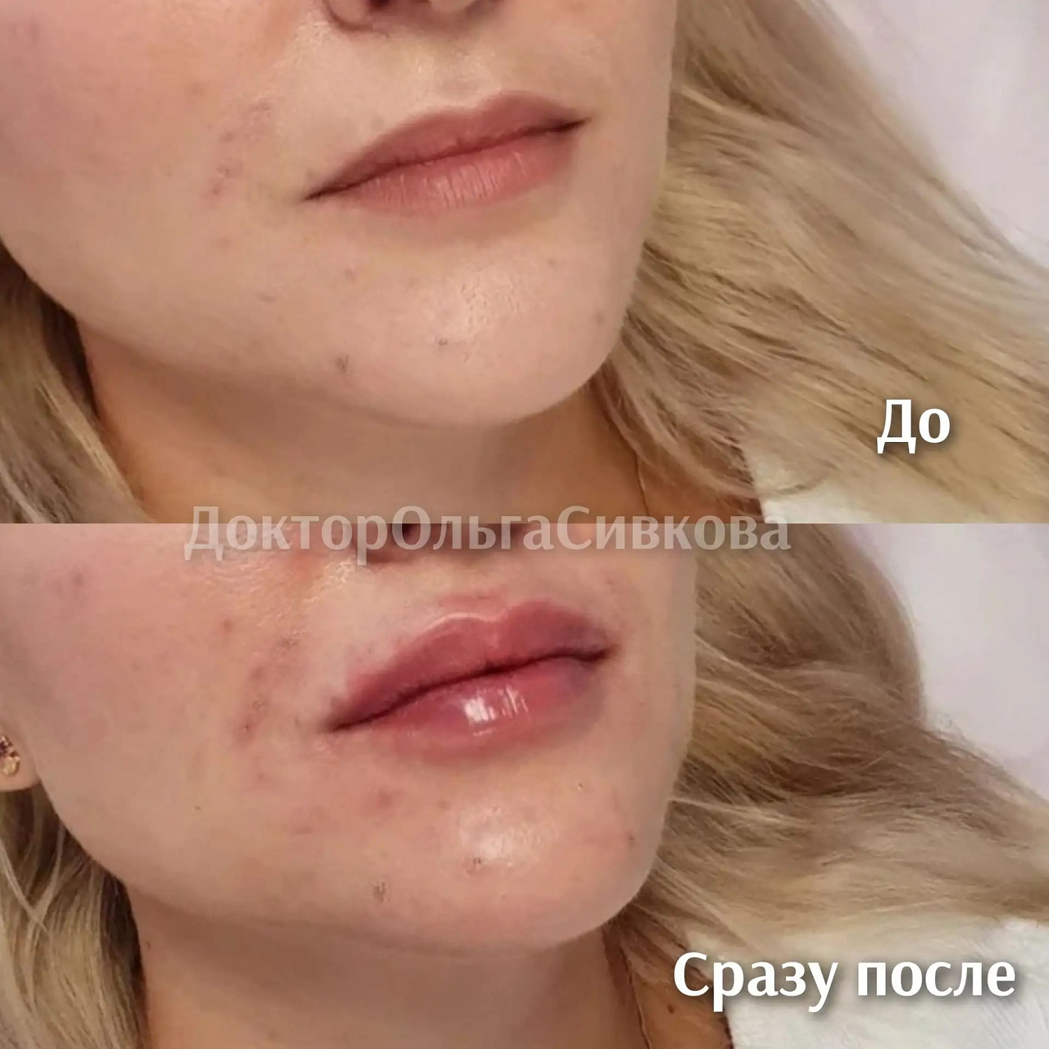 Коррекция губ