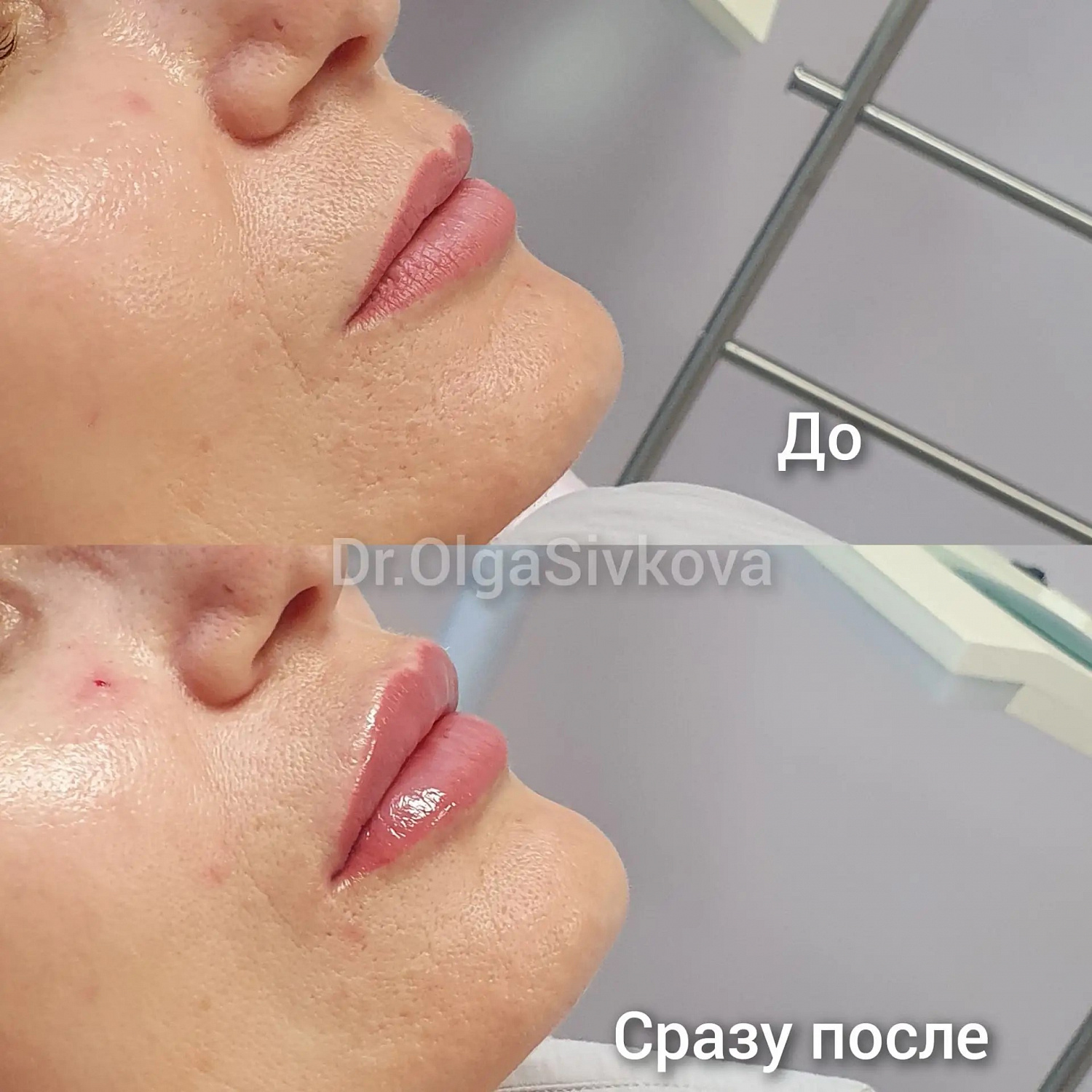Коррекция губ