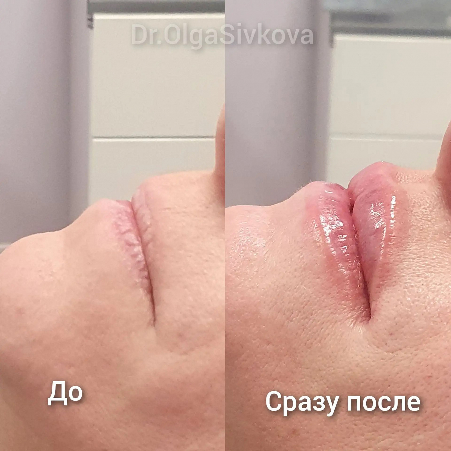 Коррекция губ