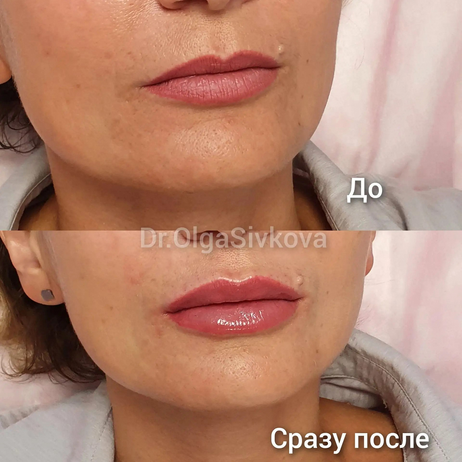Коррекция губ