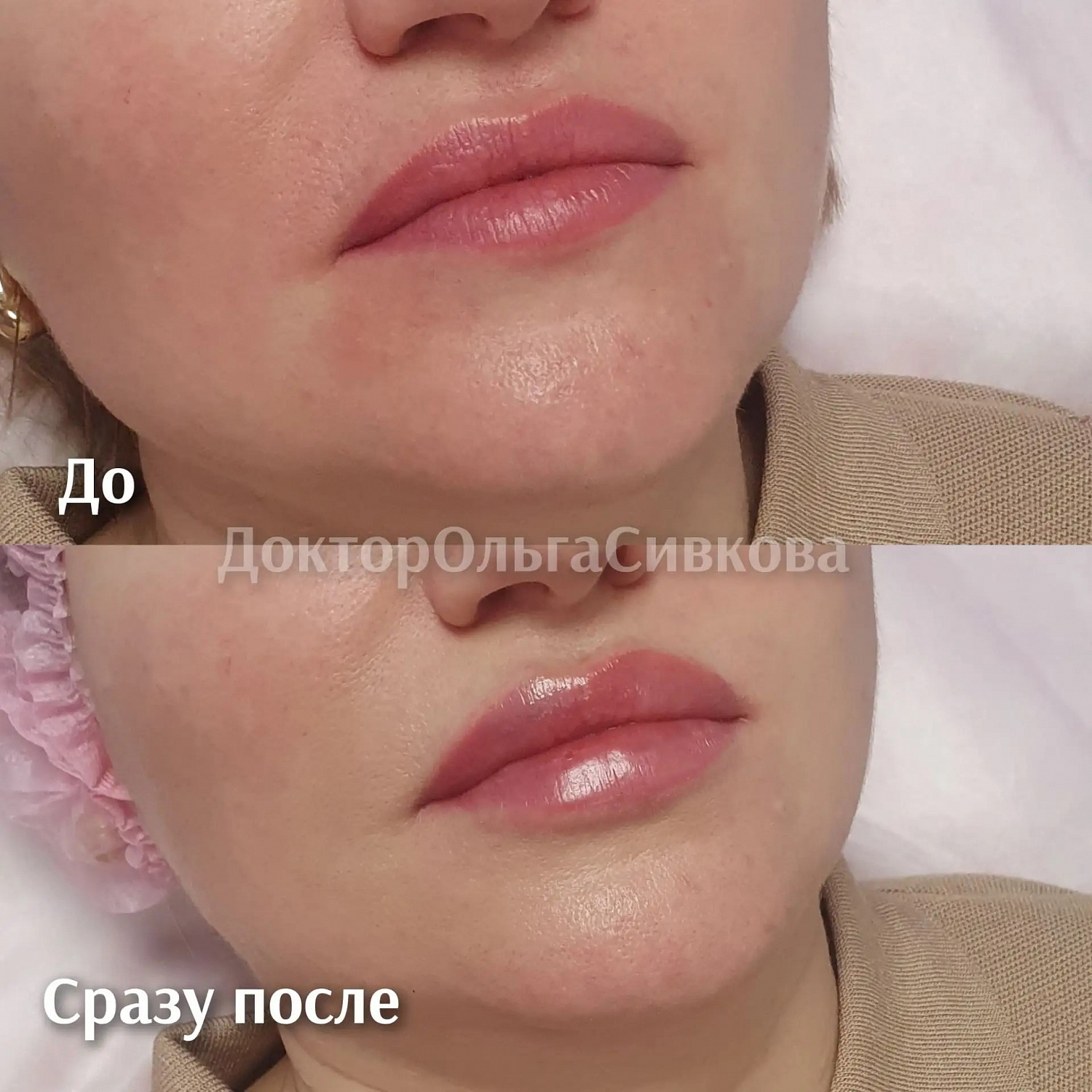 Коррекция губ
