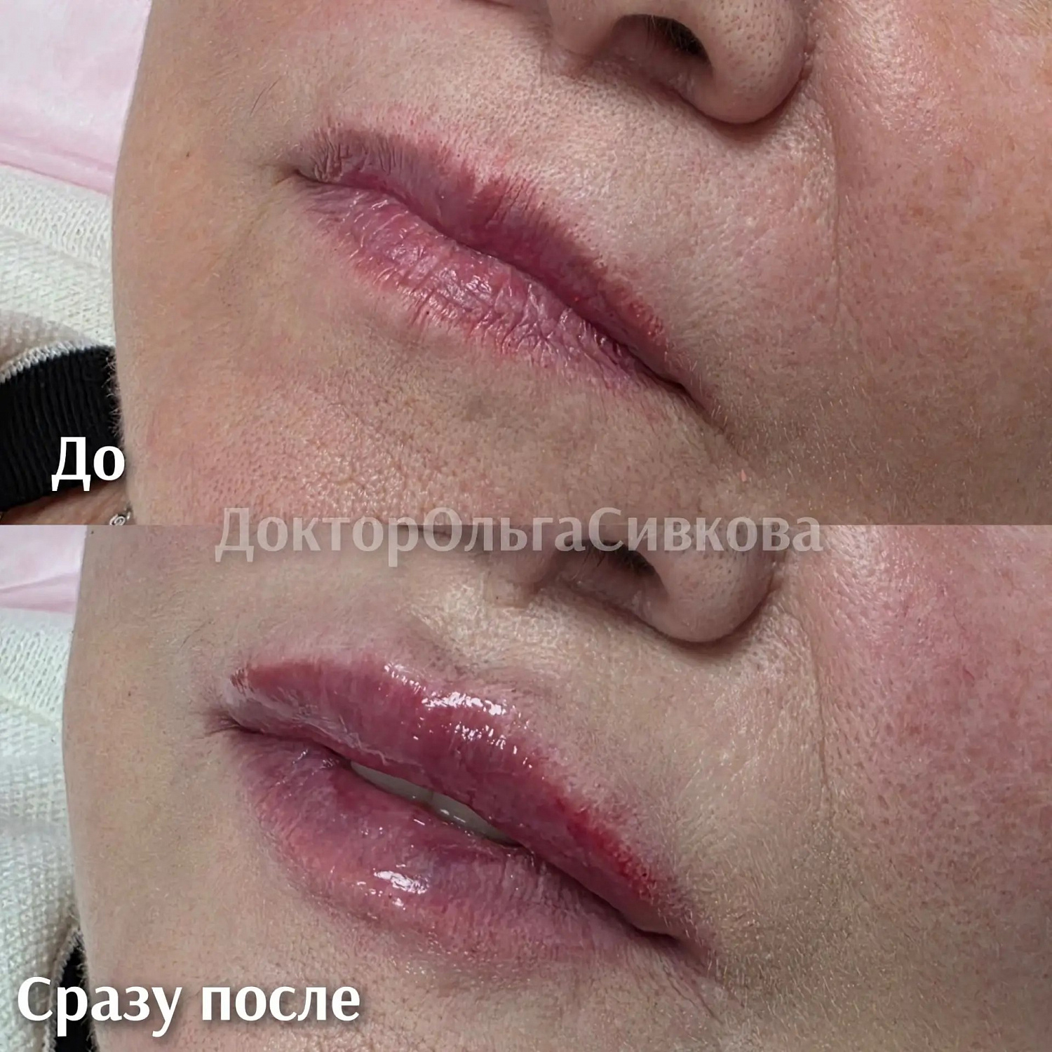 Коррекция губ